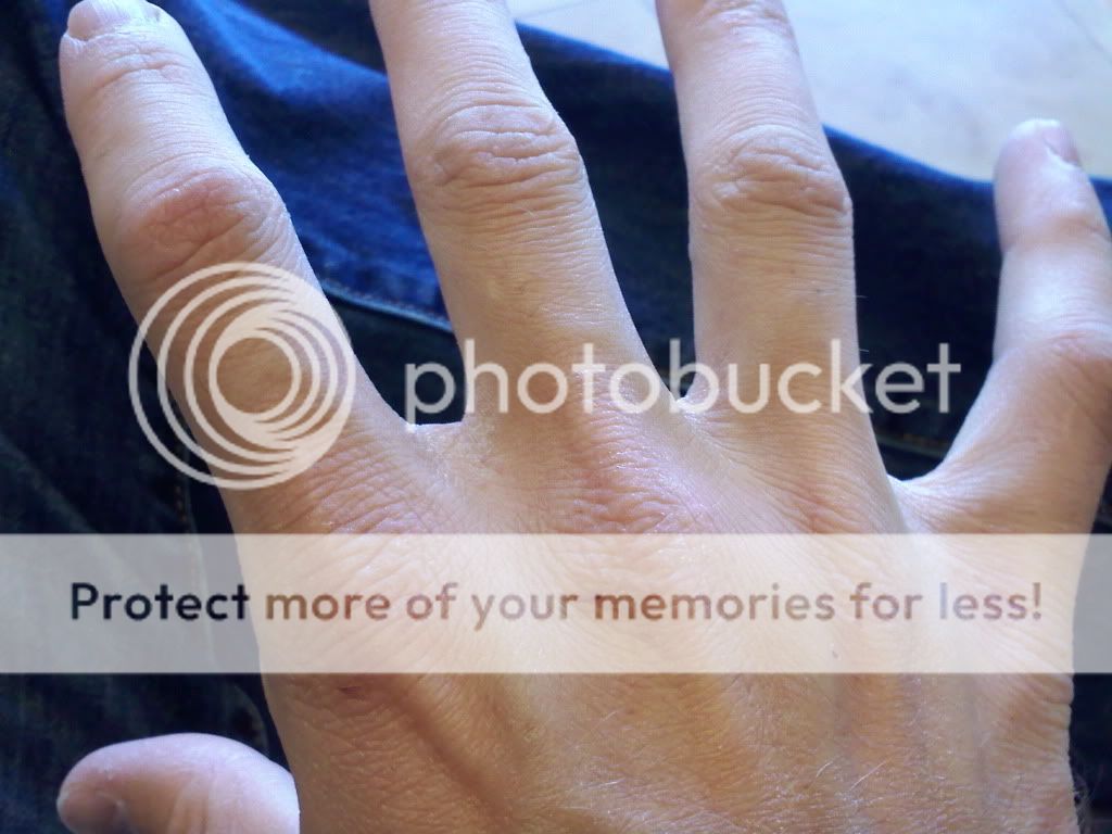 eczema? or fiberglass