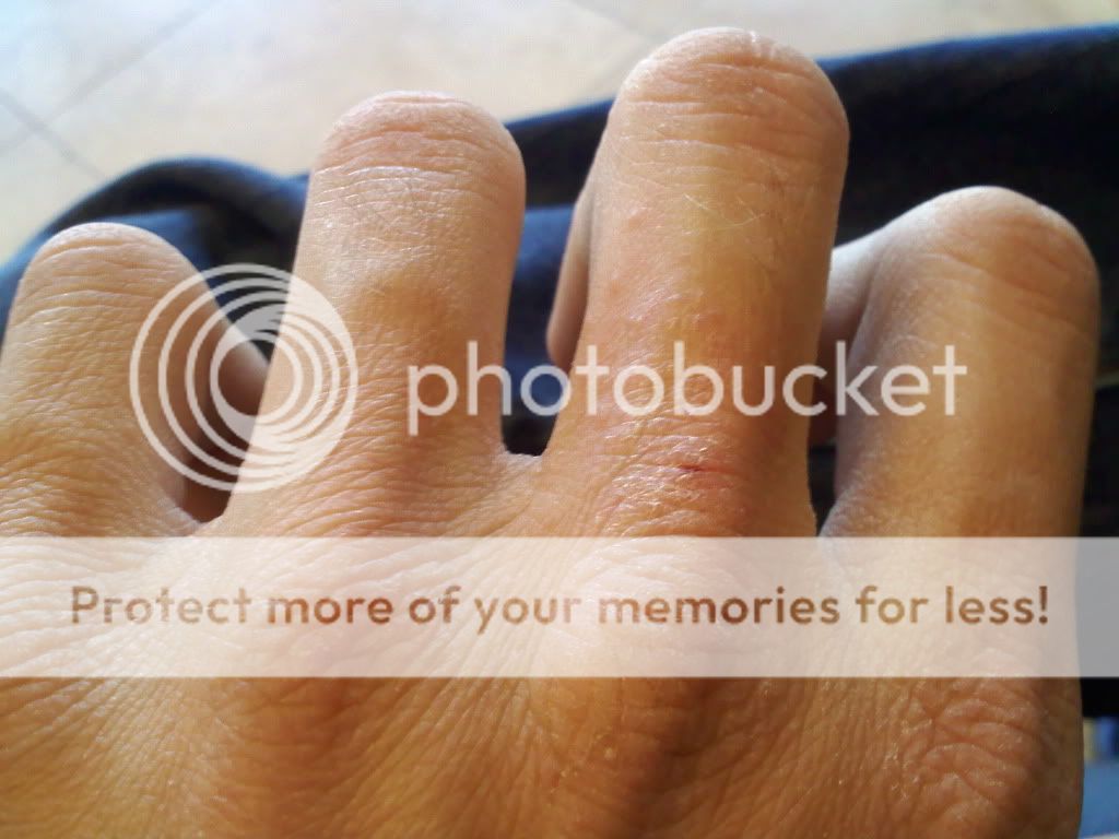 eczema? or fiberglass